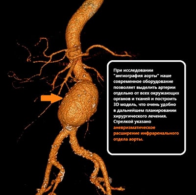 Как диагностировать патологии брюшного отдела аорты и её ветвей