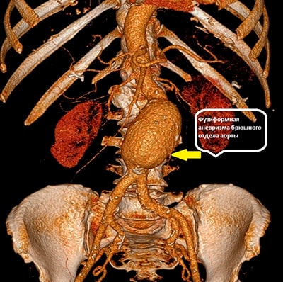 Как диагностировать патологии брюшного отдела аорты и её ветвей