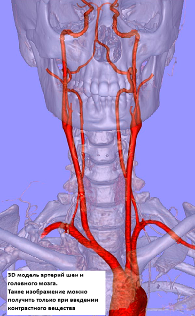 Атеросклероз аорты и её ветвей на компьютерной томографии